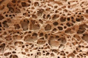 Stronger Bones, Healthier You: Understanding and Managing Osteoporosis